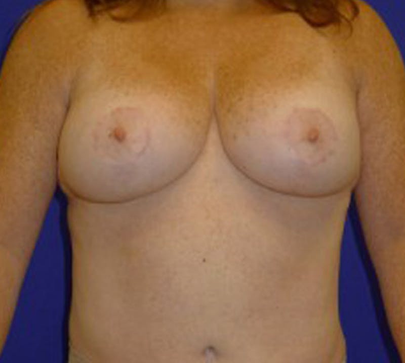 Mastopexy/Lift Before & After Gallery - Patient 175169317 - Image 2
