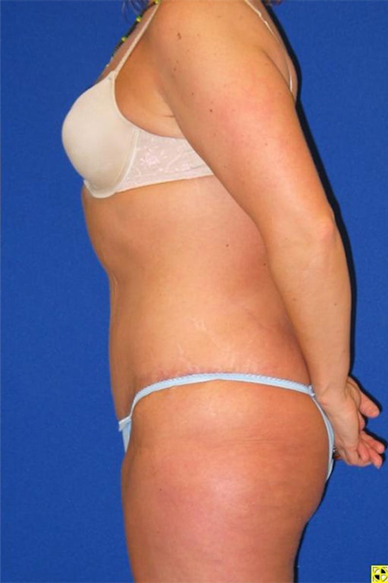 Extended Abdominoplasty Before & After Gallery - Patient 175169319 - Image 6