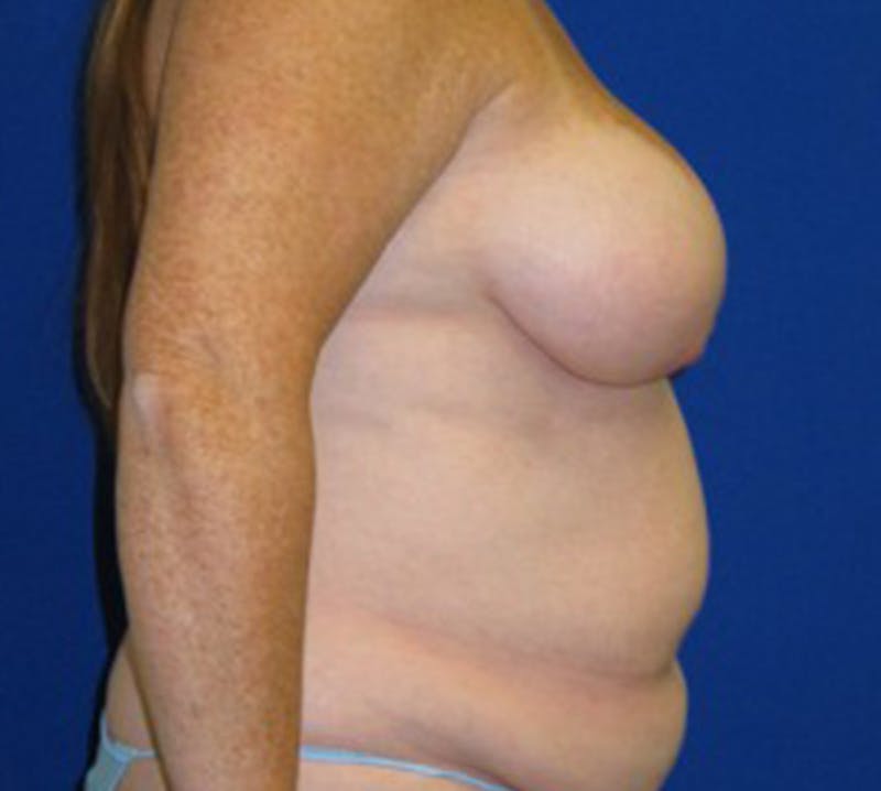 Mastopexy/Lift Before & After Gallery - Patient 175169317 - Image 3