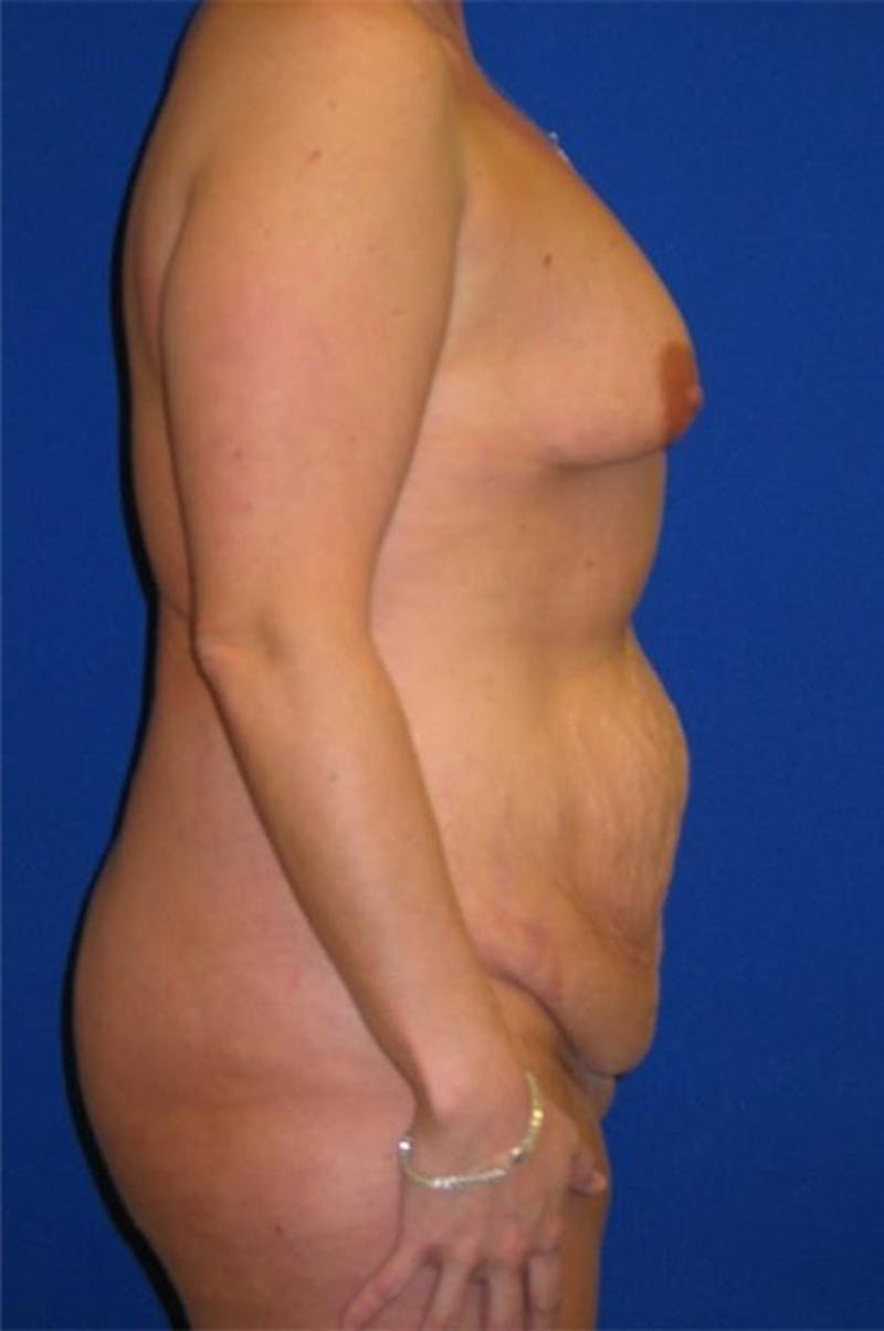 Extended Abdominoplasty Before & After Gallery - Patient 175169319 - Image 7