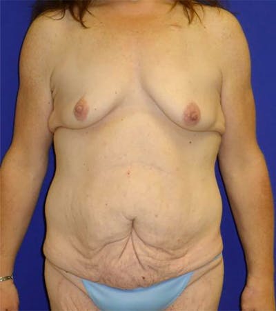 Extended Abdominoplasty Before & After Gallery - Patient 175169337 - Image 1