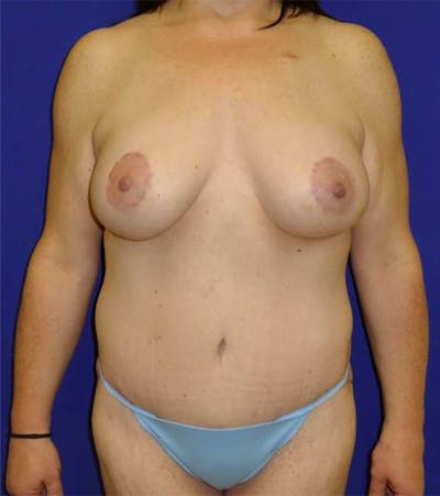 Extended Abdominoplasty Before & After Gallery - Patient 175169337 - Image 2