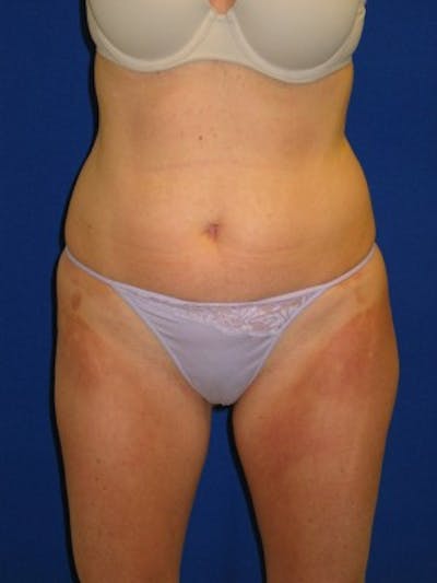 Liposuction Before & After Gallery - Patient 175169339 - Image 1
