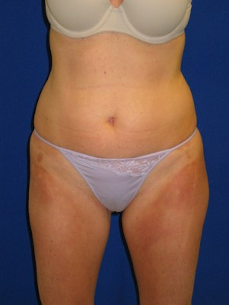 Liposuction Before & After Gallery - Patient 175169339 - Image 1