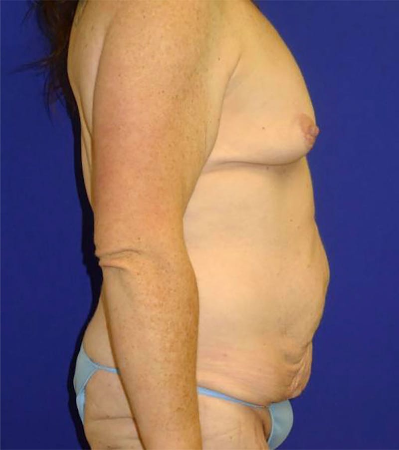 Extended Abdominoplasty Before & After Gallery - Patient 175169337 - Image 3