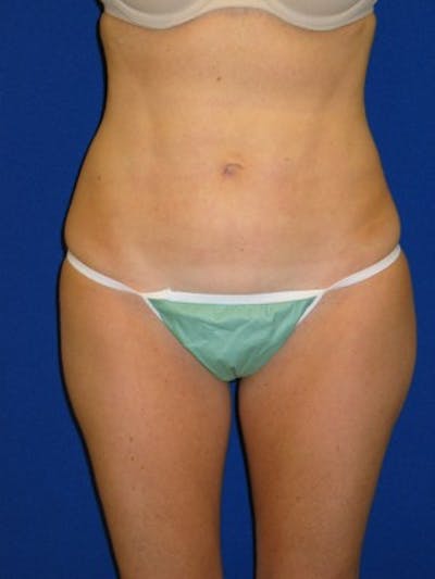 Liposuction Before & After Gallery - Patient 175169339 - Image 2