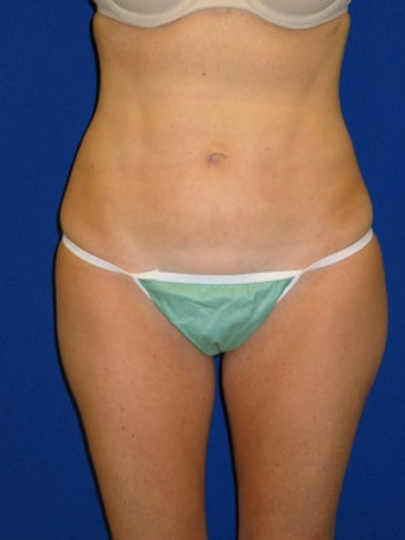 Liposuction Before & After Gallery - Patient 175169339 - Image 2