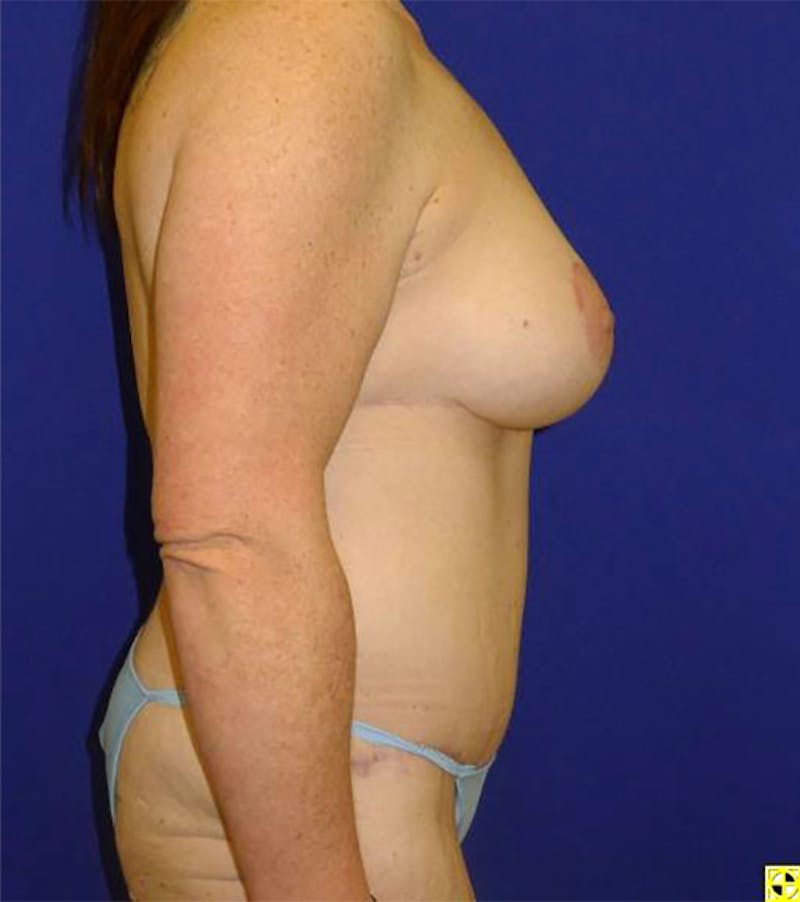 Extended Abdominoplasty Before & After Gallery - Patient 175169337 - Image 4