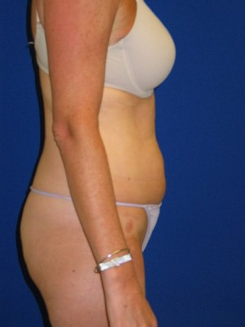 Liposuction Before & After Gallery - Patient 175169339 - Image 3