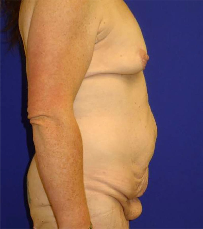 Extended Abdominoplasty Before & After Gallery - Patient 175169337 - Image 5