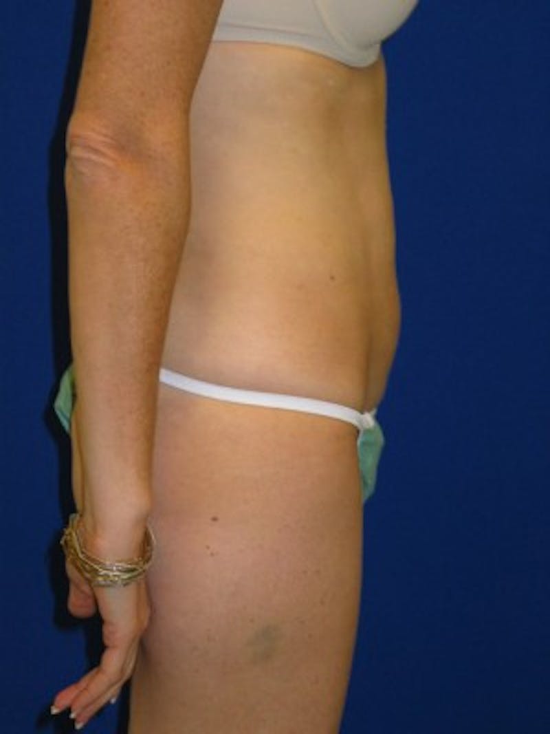 Liposuction Before & After Gallery - Patient 175169339 - Image 4