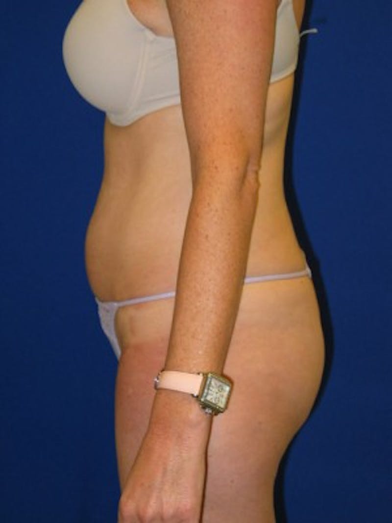 Liposuction Before & After Gallery - Patient 175169339 - Image 5