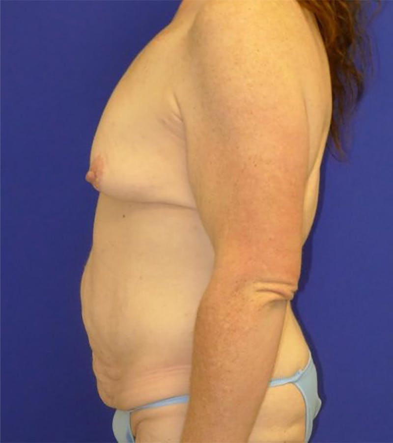 Extended Abdominoplasty Before & After Gallery - Patient 175169337 - Image 7