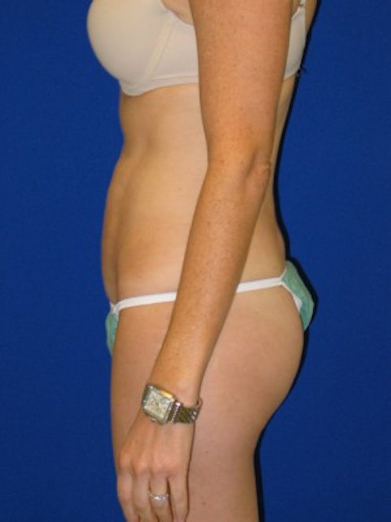 Liposuction Before & After Gallery - Patient 175169339 - Image 6