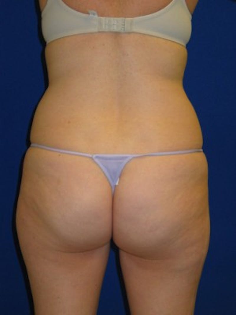 Liposuction Before & After Gallery - Patient 175169339 - Image 7