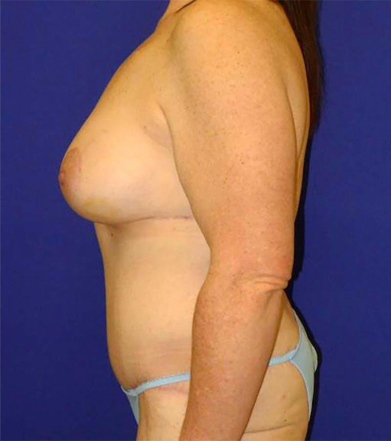 Extended Abdominoplasty Before & After Gallery - Patient 175169337 - Image 8