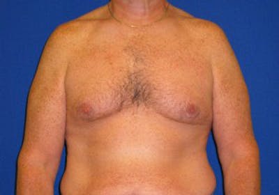 Gynecomastia Before & After Gallery - Patient 175169347 - Image 1