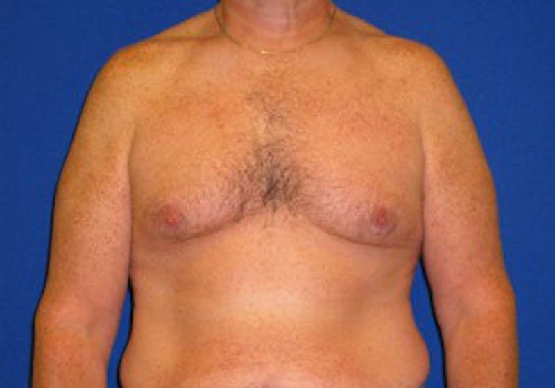 Gynecomastia Before & After Gallery - Patient 175169347 - Image 1