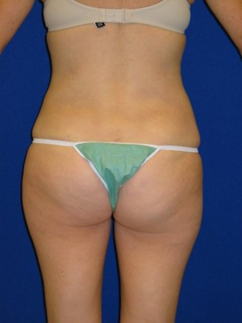 Liposuction Before & After Gallery - Patient 175169339 - Image 8