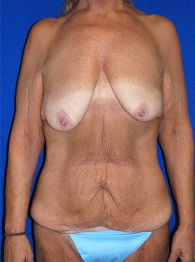 Extended Abdominoplasty Before & After Gallery - Patient 175169357 - Image 1