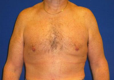 Gynecomastia Before & After Gallery - Patient 175169347 - Image 2
