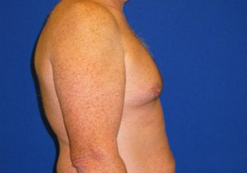 Gynecomastia Before & After Gallery - Patient 175169347 - Image 3