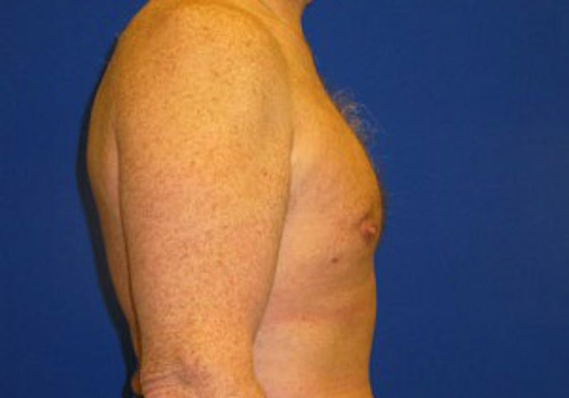Gynecomastia Before & After Gallery - Patient 175169347 - Image 4