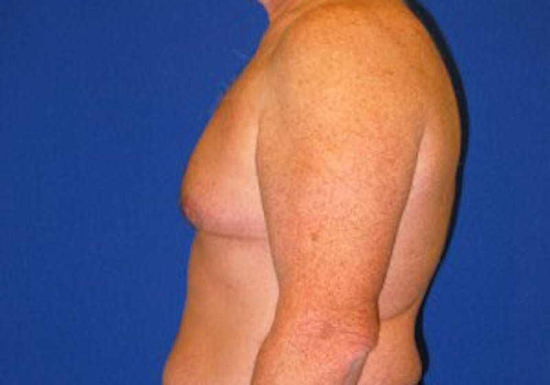 Gynecomastia Before & After Gallery - Patient 175169347 - Image 5