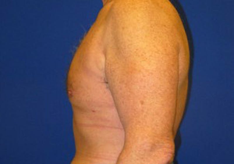 Gynecomastia Before & After Gallery - Patient 175169347 - Image 6