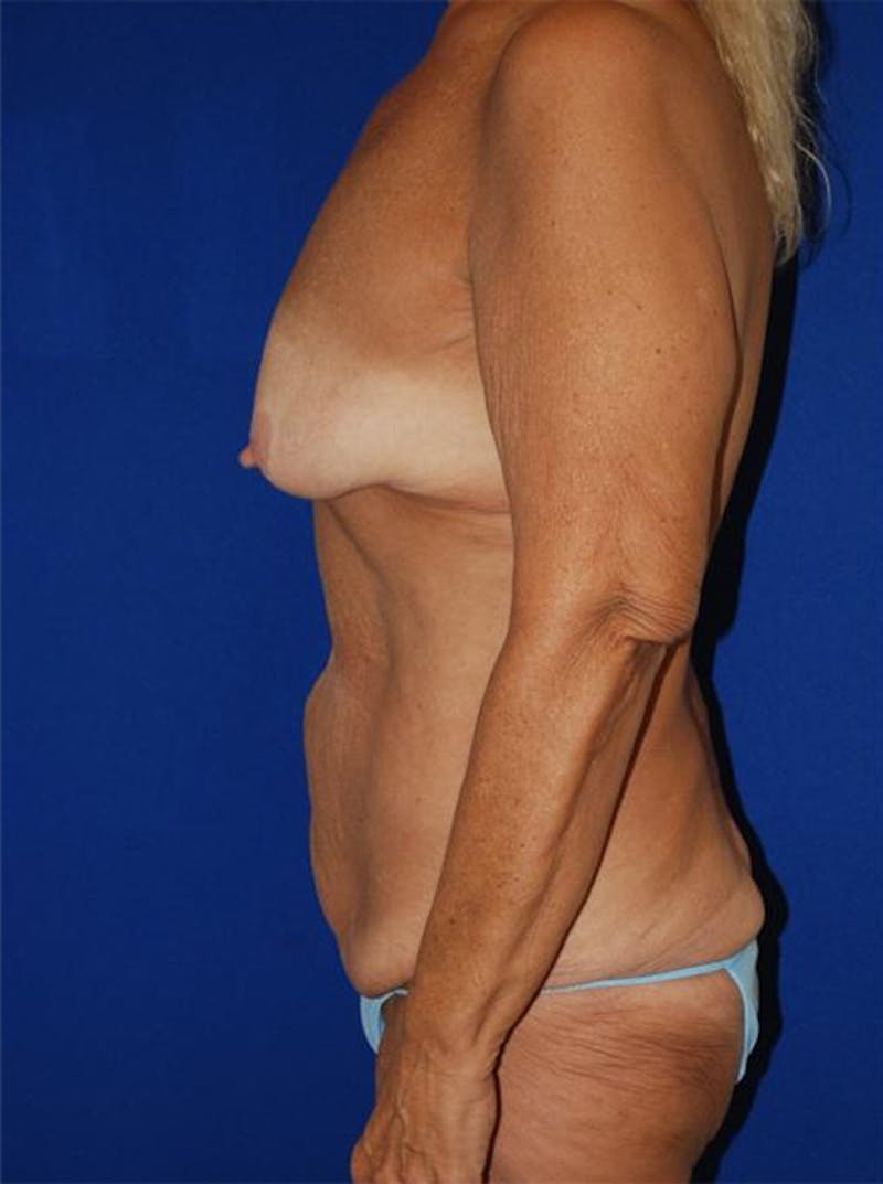 Extended Abdominoplasty Before & After Gallery - Patient 175169357 - Image 5