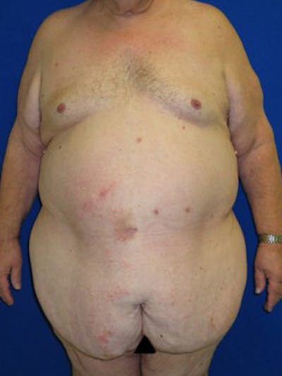 Panniculectomy Before & After Gallery - Patient 175169375 - Image 1