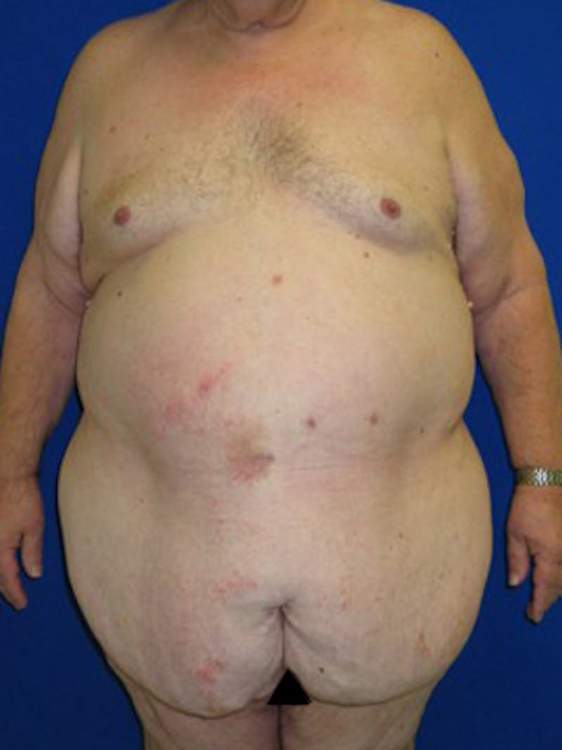 Panniculectomy Before & After Gallery - Patient 175169375 - Image 1