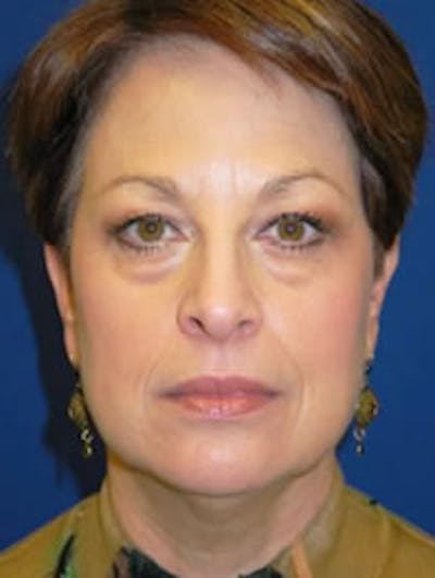 Facelift Before & After Gallery - Patient 175169358 - Image 1