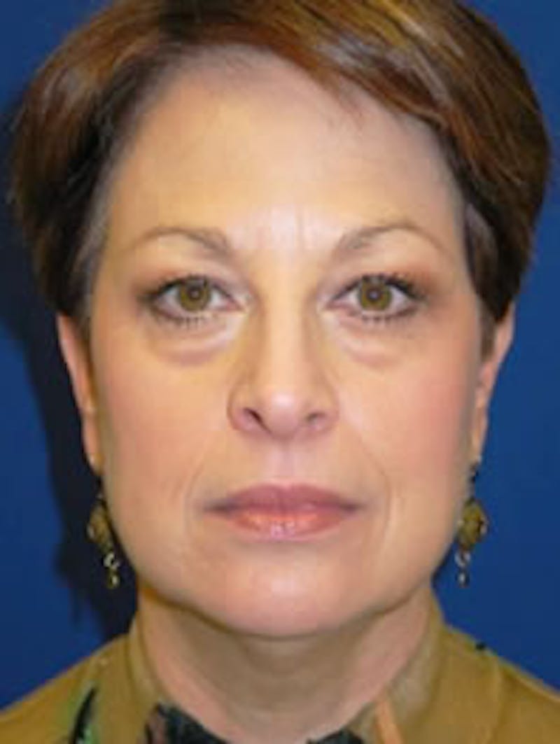 Facelift Before & After Gallery - Patient 175169358 - Image 1