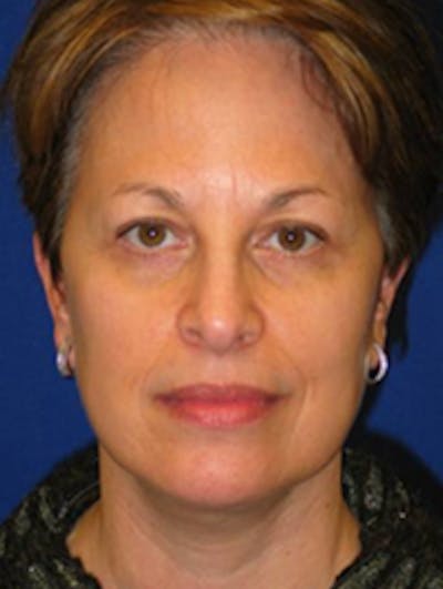Facelift Before & After Gallery - Patient 175169358 - Image 2