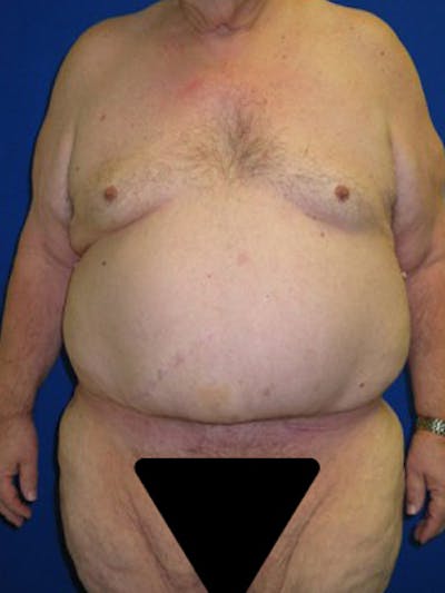 Panniculectomy Before & After Gallery - Patient 175169375 - Image 2