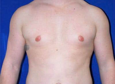 Gynecomastia Before & After Gallery - Patient 175169362 - Image 1