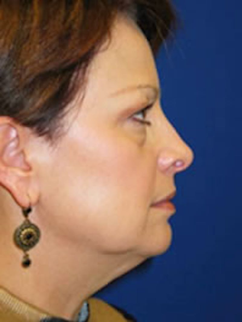 Facelift Before & After Gallery - Patient 175169358 - Image 3