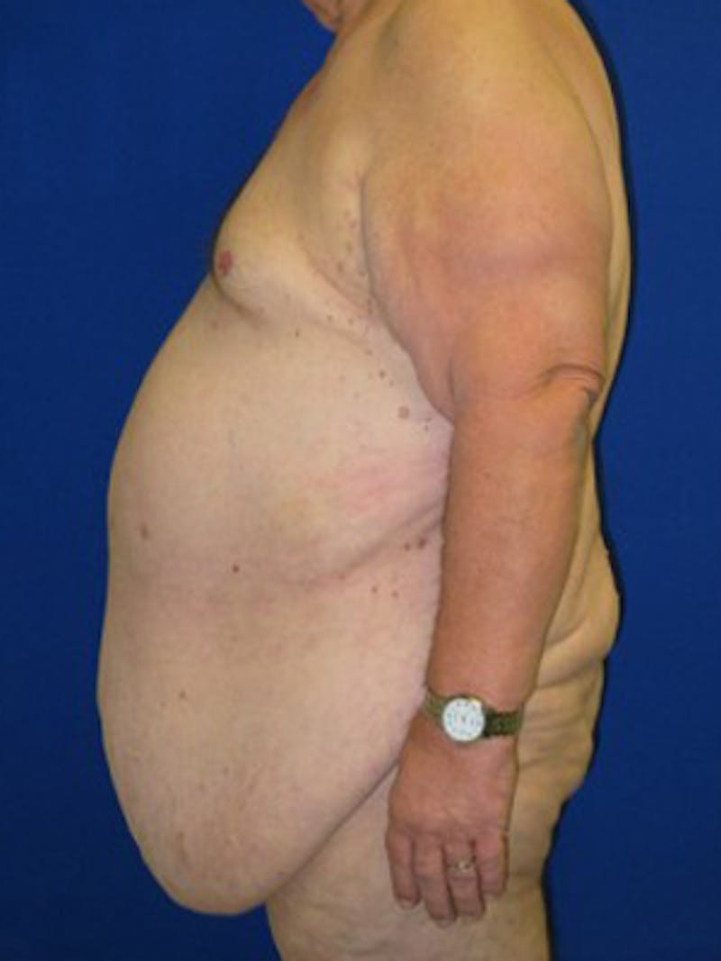 Panniculectomy Before & After Gallery - Patient 175169375 - Image 3