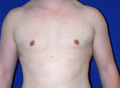 Gynecomastia Before & After Gallery - Patient 175169362 - Image 2