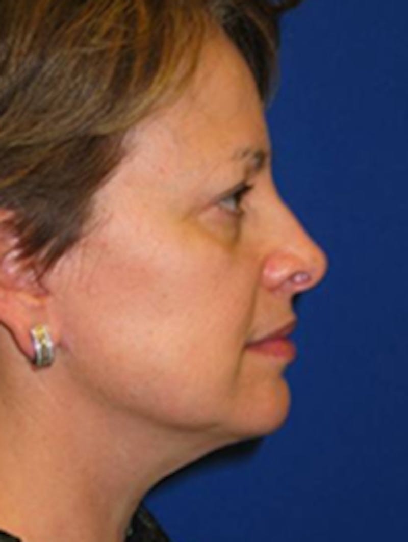 Facelift Before & After Gallery - Patient 175169358 - Image 4