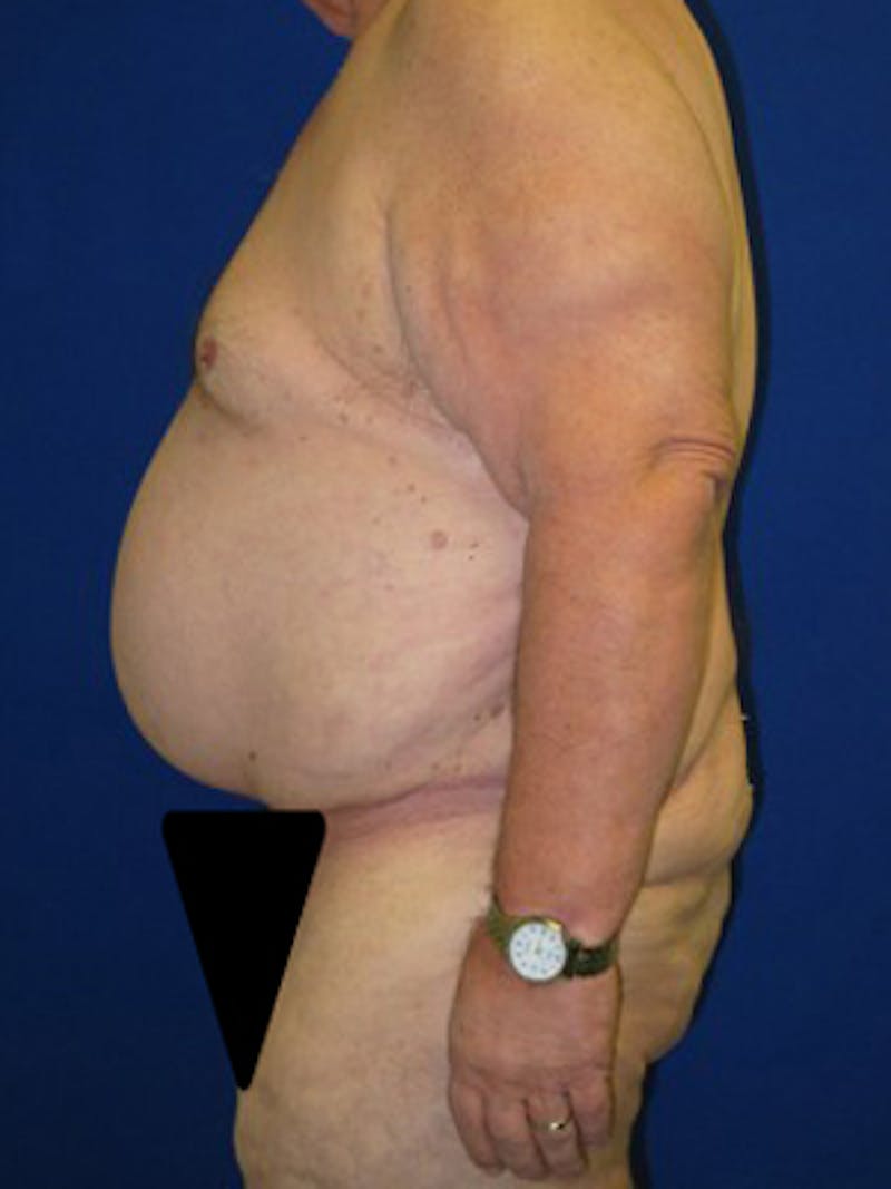 Panniculectomy Before & After Gallery - Patient 175169375 - Image 4