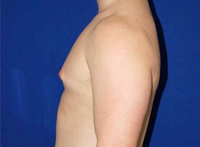 Gynecomastia Before & After Gallery - Patient 175169362 - Image 3