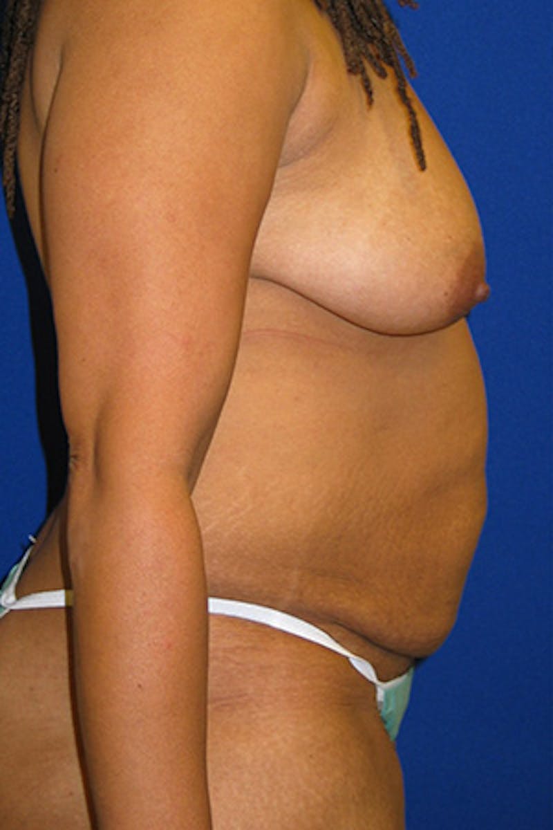 Abdominoplasty Before & After Gallery - Patient 175169366 - Image 3