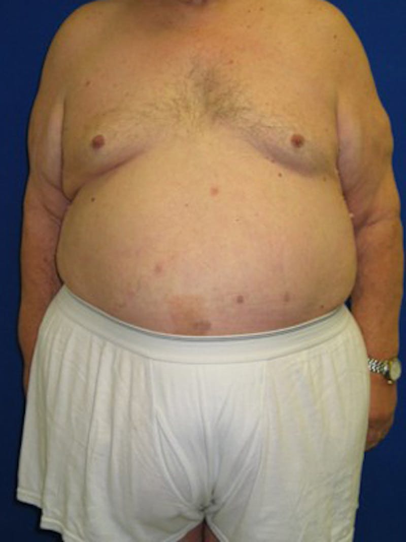 Panniculectomy Before & After Gallery - Patient 175169375 - Image 5