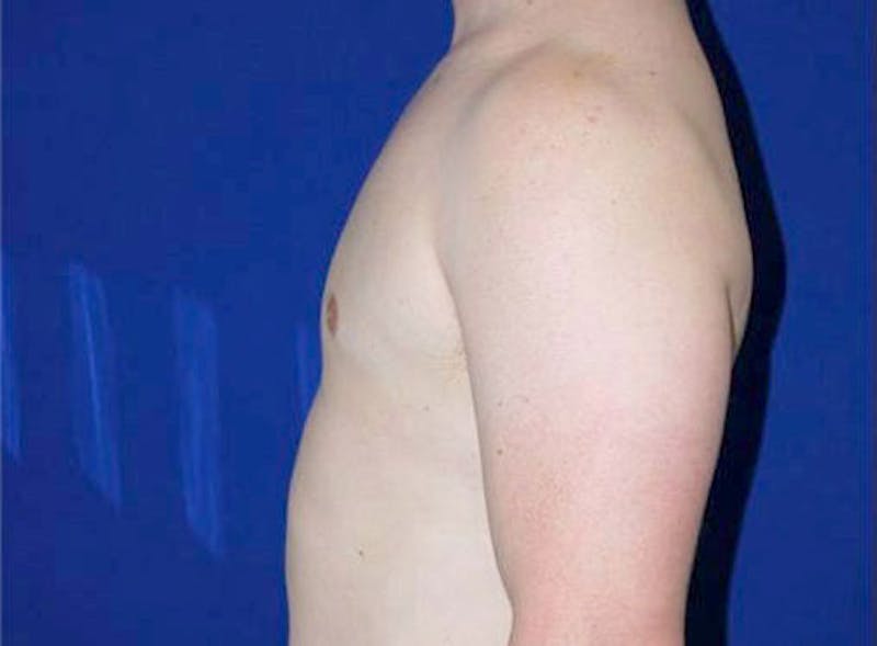Gynecomastia Before & After Gallery - Patient 175169362 - Image 4
