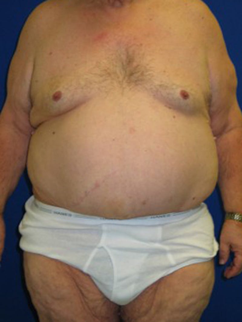 Panniculectomy Before & After Gallery - Patient 175169375 - Image 6