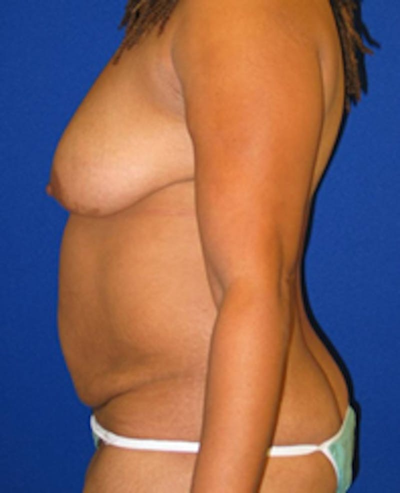 Abdominoplasty Before & After Gallery - Patient 175169366 - Image 5