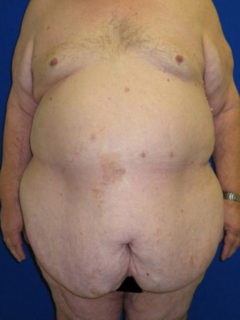 Panniculectomy Before & After Gallery - Patient 175169375 - Image 7