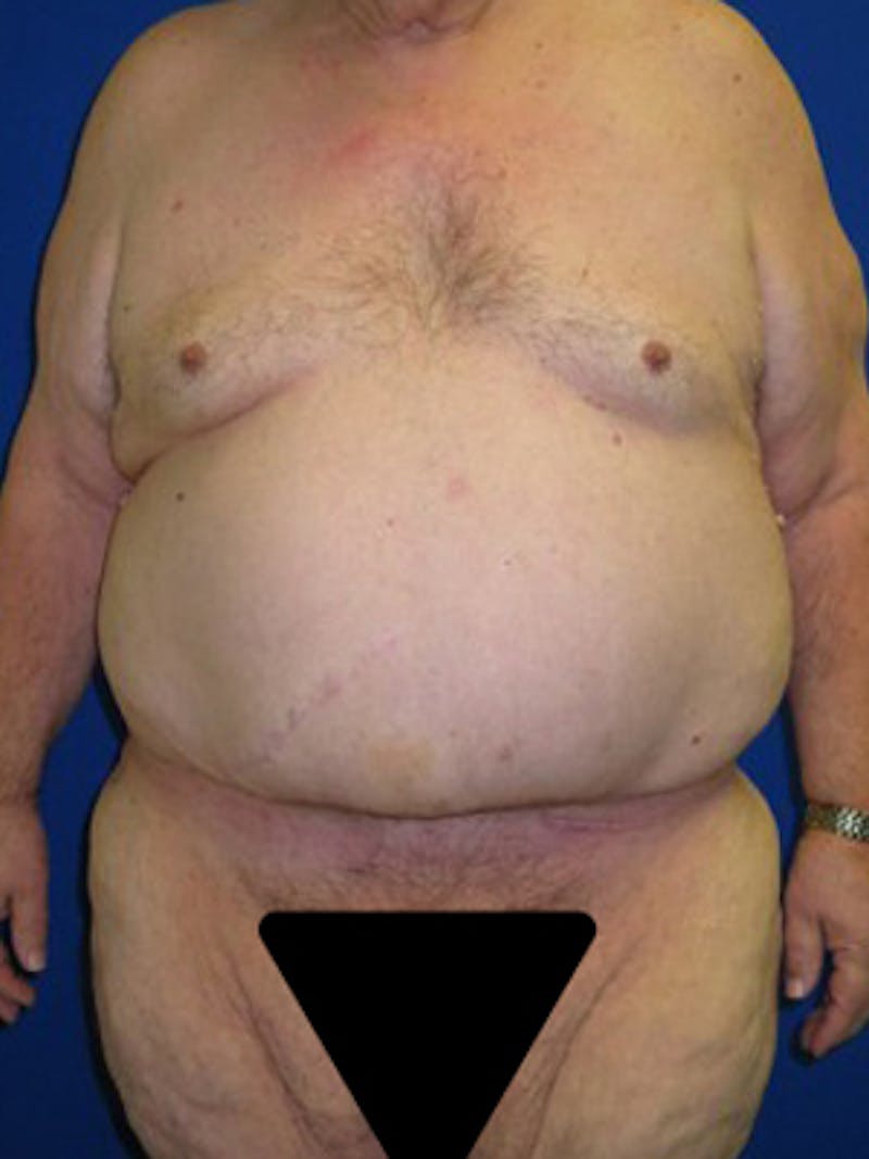 Panniculectomy Before & After Gallery - Patient 175169375 - Image 8